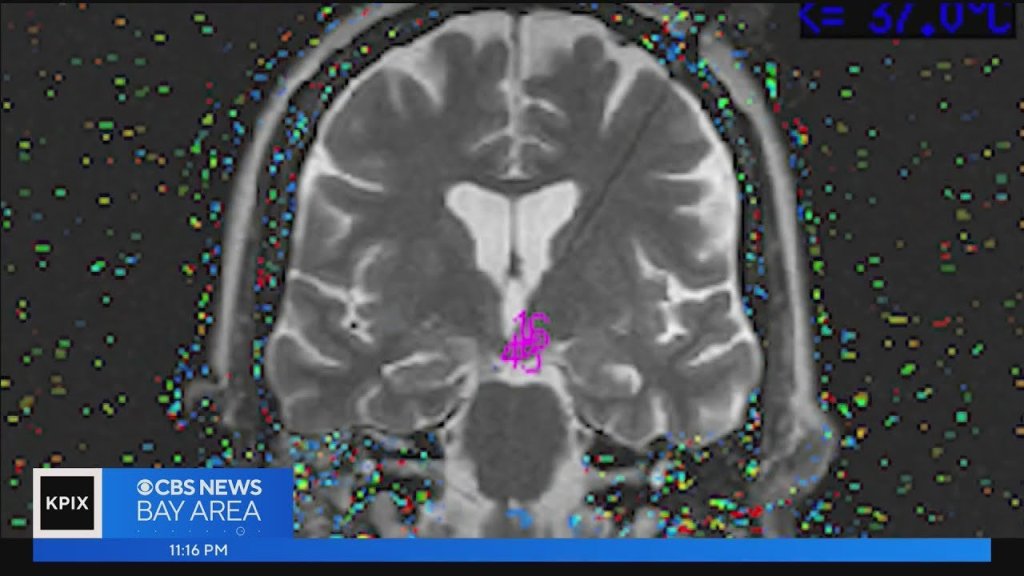 Debbie Menzies; unexplained illness; Golden Gate Bridge; suicide prevention