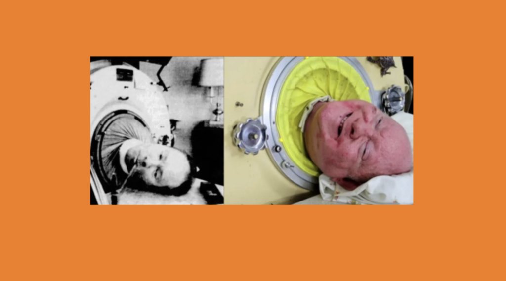 Images of a younger and older Paul Alexander in his iron lung