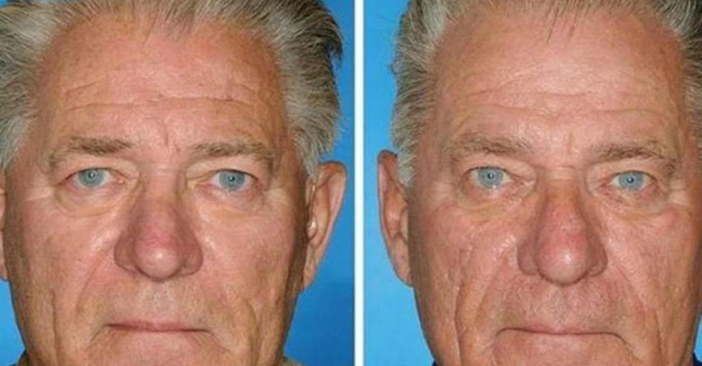 smokers versus non-smokers, smokers' skin, twins