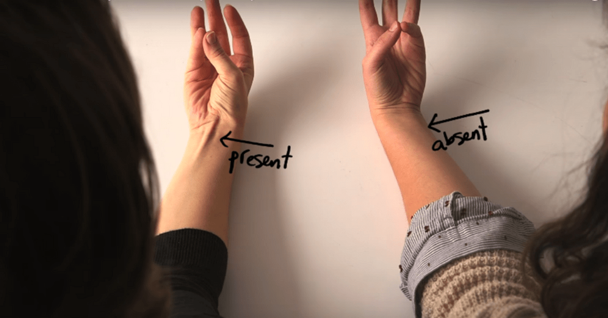 one arm with vestigial organ beside one without