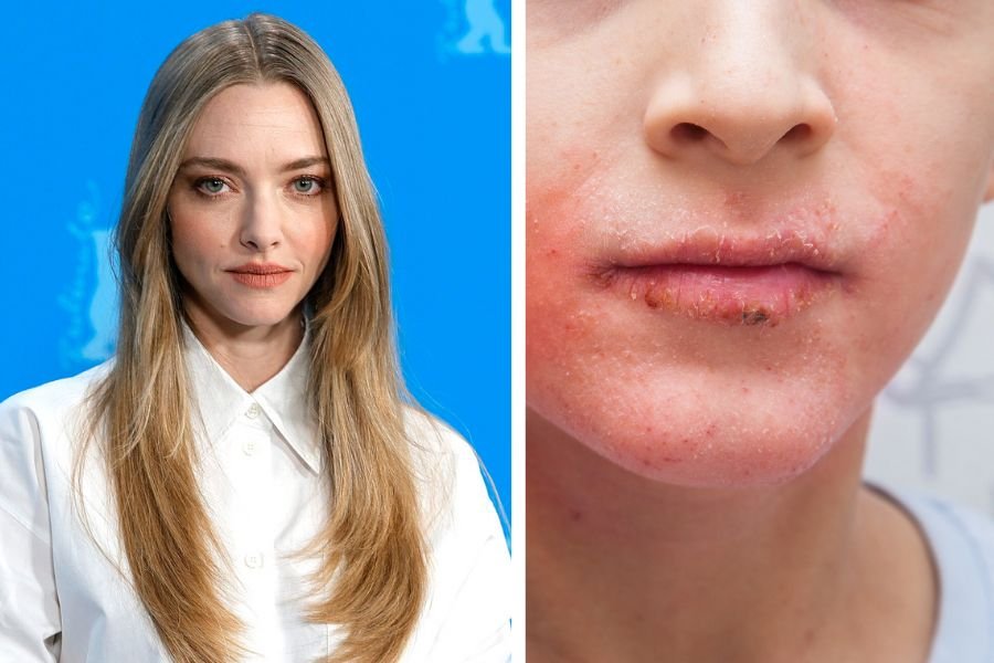 amanda seyfried, amanda seyfried skin, amanda seyfried vogue, Amanda Seyfried eczema, eczema on face