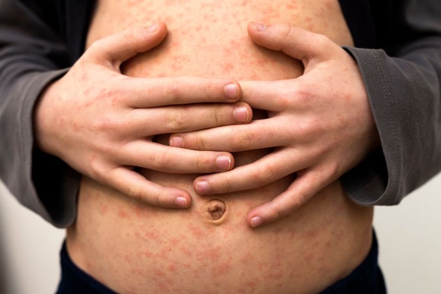 measles rash