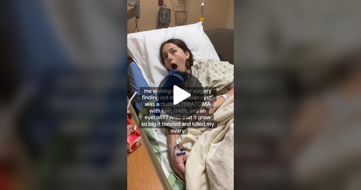 teratoma, tumor, cancer, women's health, women, health, hospital, doctor, OBGYN, reproductive health, ovarian cyst