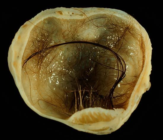 teratoma, tumor, cancer, women's health, women, health, hospital, doctor, OBGYN, reproductive health, ovarian cyst