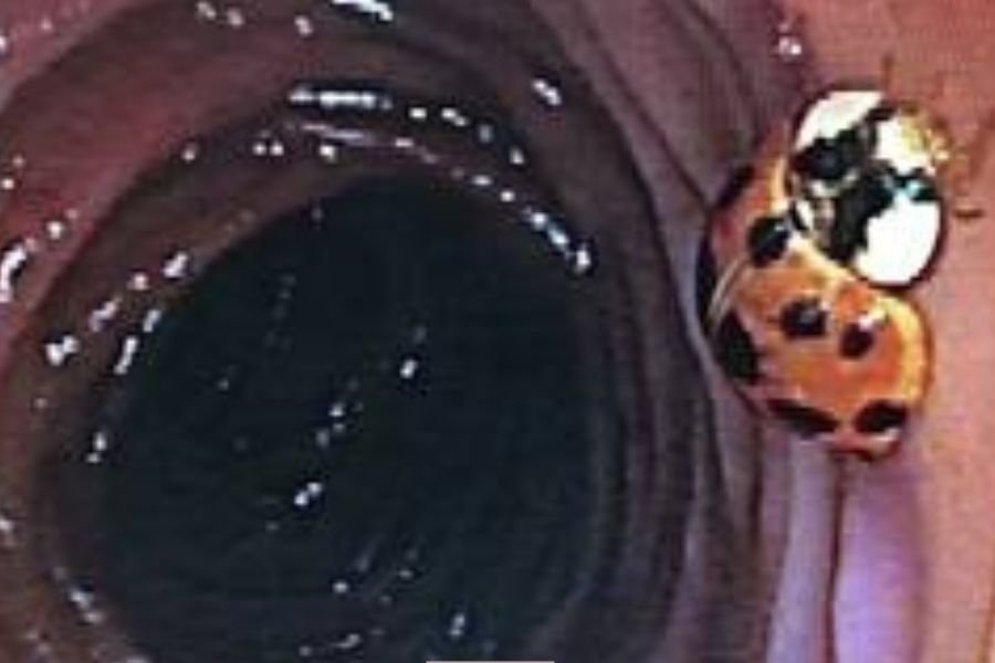colonoscopy ladybug; ladybug; colonoscopy surprises; bug during colonoscopy; colonoscopy prep
