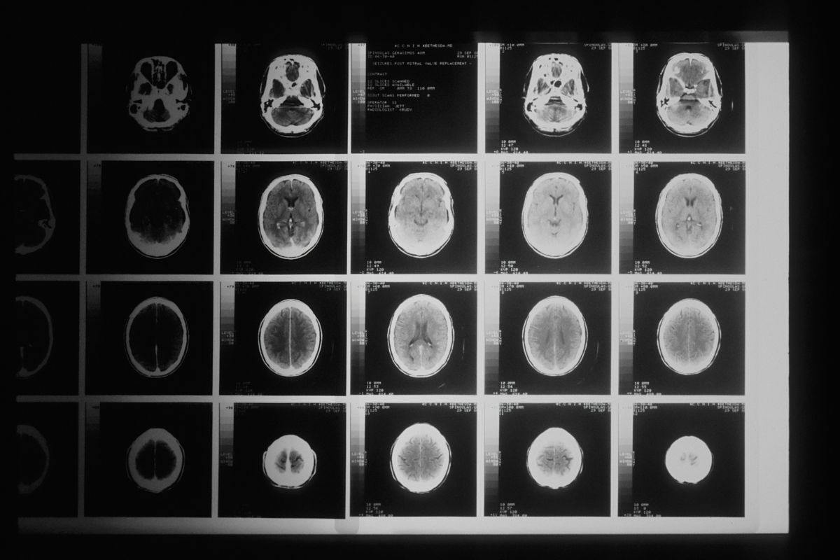 DIPG, cancer, childhood cancer, clinical trial, pediatric medicine