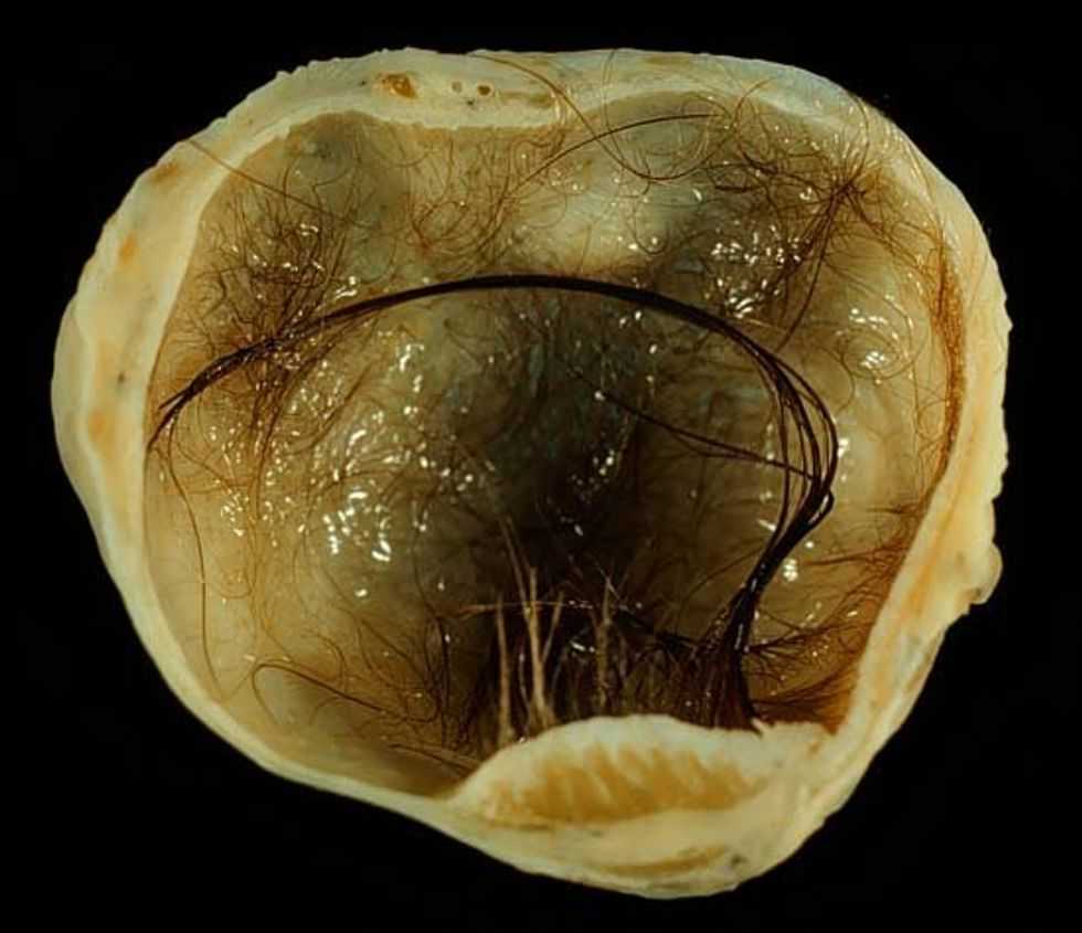 teratoma, ovarian cyst, women's health, viral TikTok, Savannah Stuthers, medical story, patient advocacy, tumor with teeth, health education, gynecology