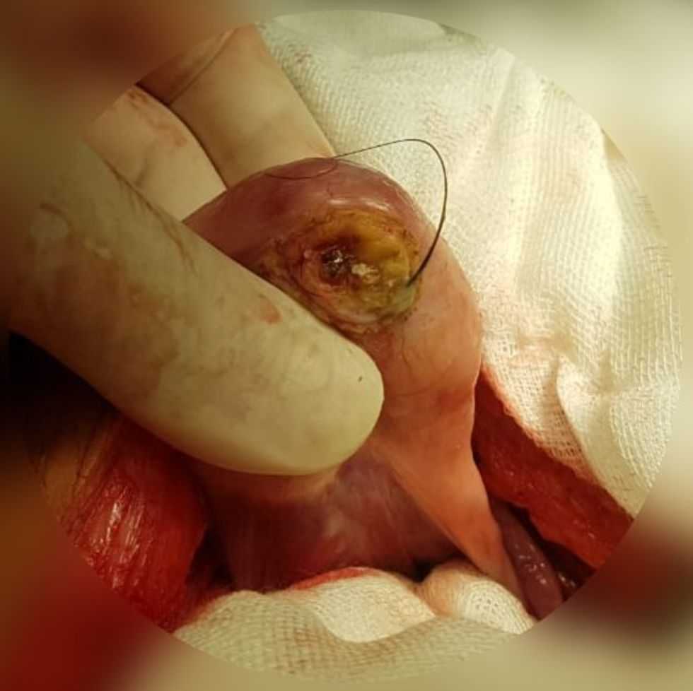 teratoma, ovarian cyst, women's health, viral TikTok, Savannah Stuthers, medical story, patient advocacy, tumor with teeth, health education, gynecology