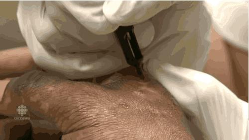 gif of tattoo needle covering scarring on a hand