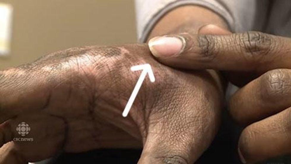 someone showing scarring on their hands