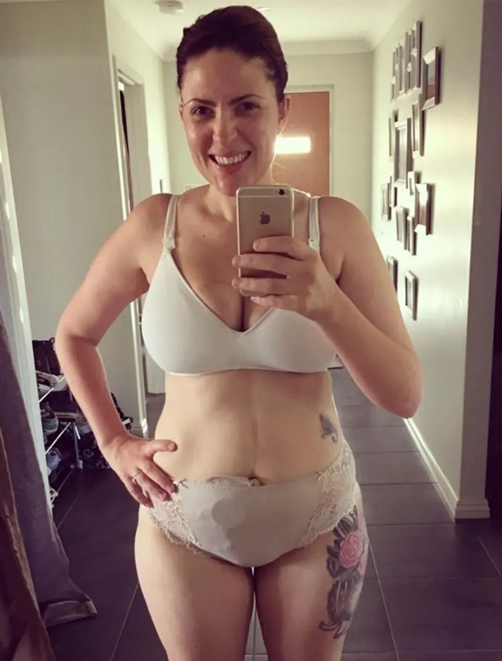 woman in underwear shows her colostomy bag
