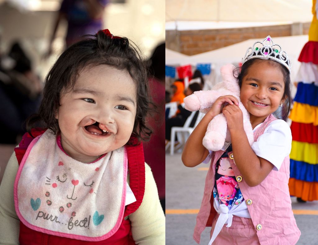 Lilia at age 1, before surgery, and at age 5, 4 years post-surgery.